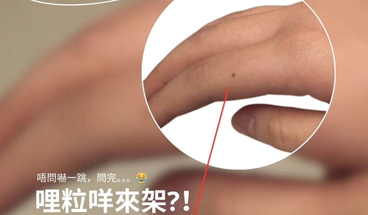 手指上的黑點
